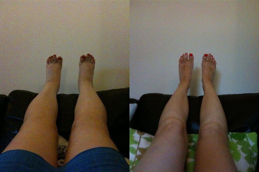 Effective result before and after applying Ostelife Premium Plus cream by Margarita