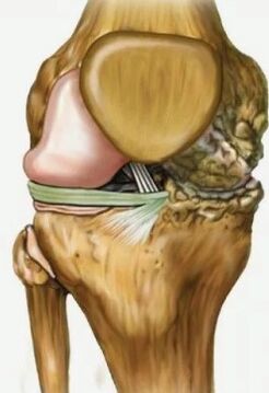 Arthritis of the knee joint