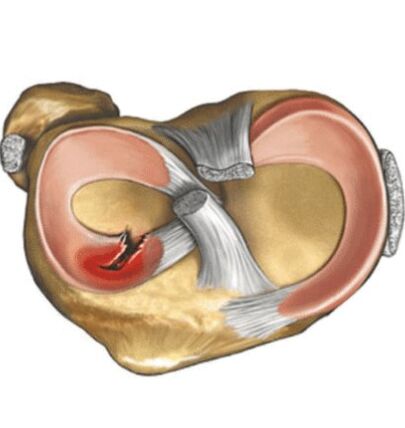Meniscus