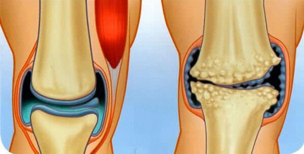 Normal state of union and causes of knee arthrosis development