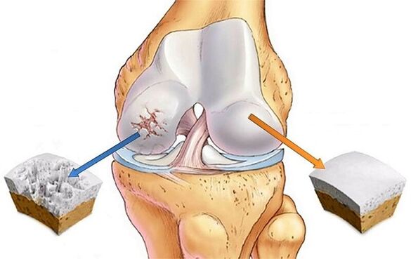 Rate and deviation for knee joint arthrosis
