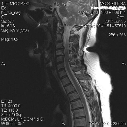 Osteochondrosis and spondylosis of the cervical back