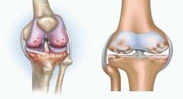 Causes of arthritis and arthritis
