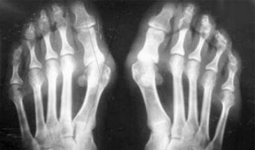 Differential diagnostics of arthritis and arthritis symptoms