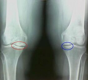 The result of the treatment of folk remedies of arthritis and arthritis