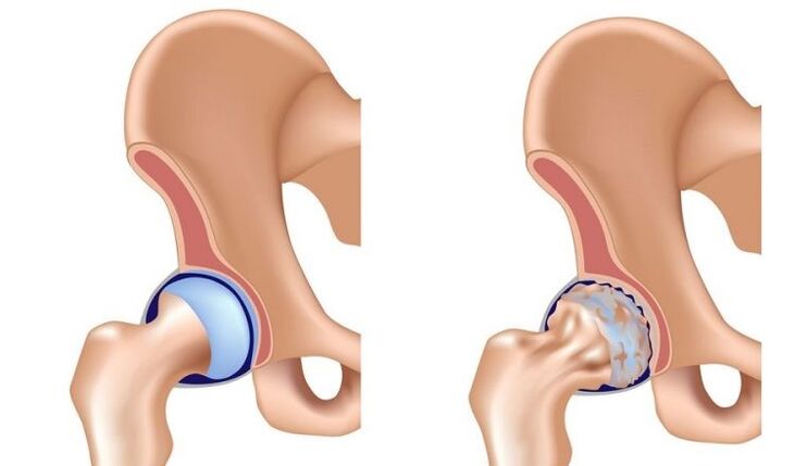 Healthy and common with arthrosis