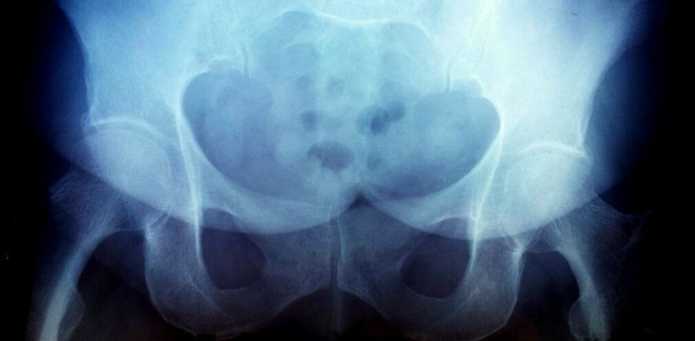 Photo X -Ray with 2nd degree arthrosis